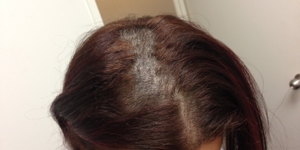 The woman's hair fell out after colour and straightening treatments.