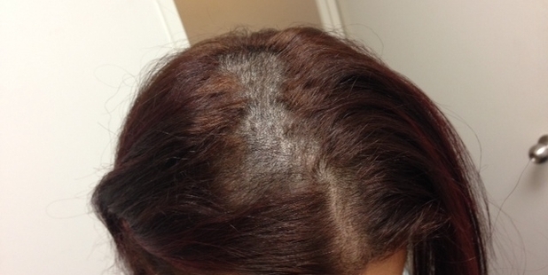 The woman was left with bald patches and scabs on her scalp. Photo / Supplied