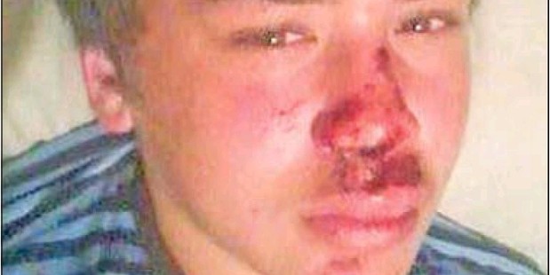 Azaleas Quenton, 12, after he was allegedly attacked by five high school students while walking home. PHOTO/SUPPLIED