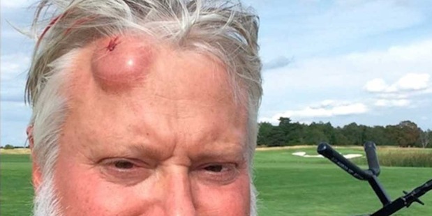 This Swedish man was hit in the head with a golf ball so hard that it looks like the actual ball broke through his skin. Photo / Twitter.
