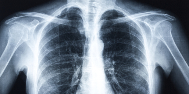Southern District Health Board has been asked to apologise a dead patient's family over a failure to review a chest X-ray. Photo / Thinkstock