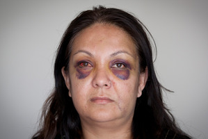 Praveet Singh was "recovering quite well" from her injuries, although the broken eye sockets could take some time to come right. Photo / Natalie Slade