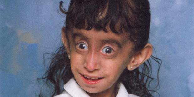 Lizzie Velasquez, aged 3. Lizzie, now 26, has a rare and undiagnosed syndrome that prevents her from putting on weight. Photo / Barcroft Media