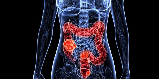 Since 2012, when the ministry rewrote the rules for access to colonoscopy, DHBs have received taxpayer top-ups of more than $11 million to do more bowel checks. Photo / iStock