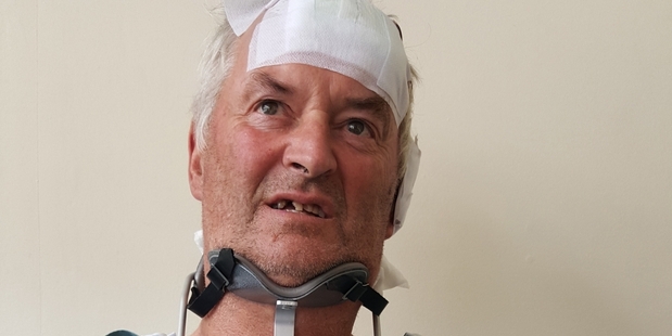 Rob Collier has a broken neck, broken arm and is minus a few teeth. Photo / Supplied
