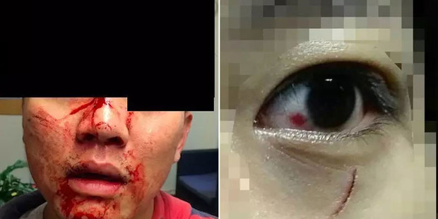 Victims of serious assaults on Asian students in Auckland.