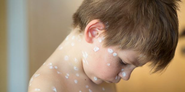 Parents and doctors needed greater awareness of the small but significant risk ibuprofen carries in chickenpox cases. Photo / Getty Images