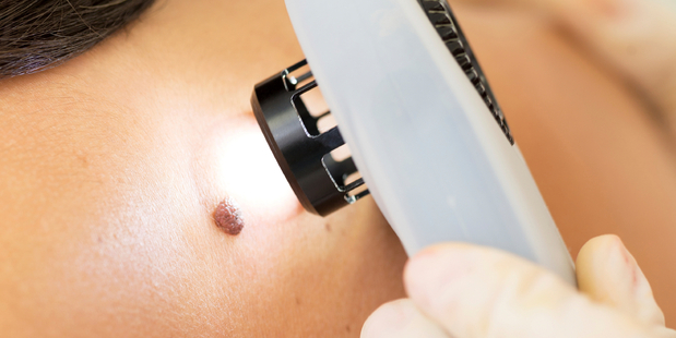What is a surprise is that our public health system does so little about melanoma. Photo / iStock