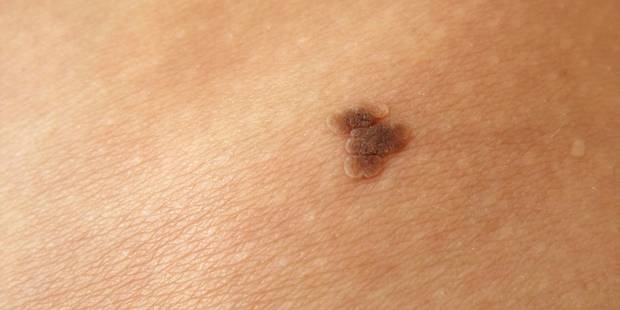 Opdivo has been approved for use by the Government for the treatment of advanced melanoma and two types of lung cancer. Photo / iStock