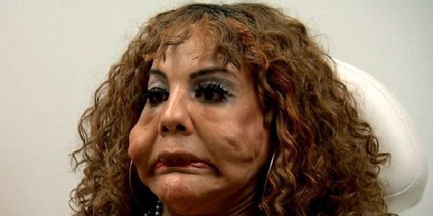 Rajee Narinesingh was a victim of doctor Oneal Ron Morris, who performed illegal surgeries using substances such as Fix-a-Flat, Super Glue and mineral oil. Photo / E!