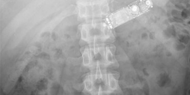 The phone moved from the man's oesophagus into his stomach. Photo / International Journal of Surgery Case Reports.