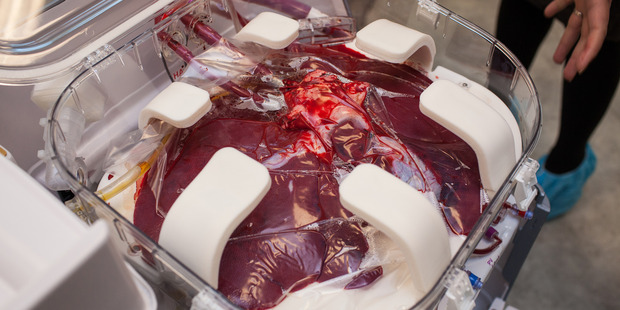The Transmedics Organ Care System takes a new approach to organ transplants. Photo / Washington Post