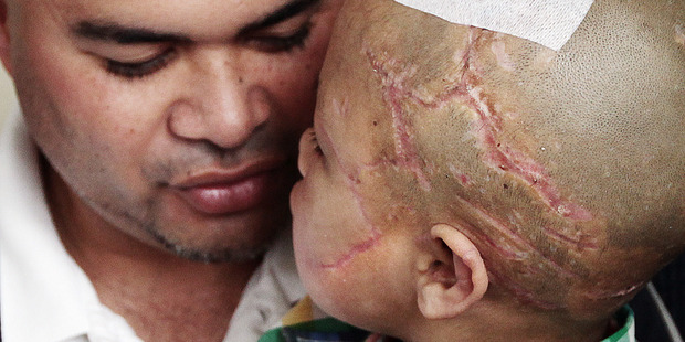 Shepherd Mea's scars pictured on September 6, 2014 - a month after he was attacked. Photo / Doug Sherring