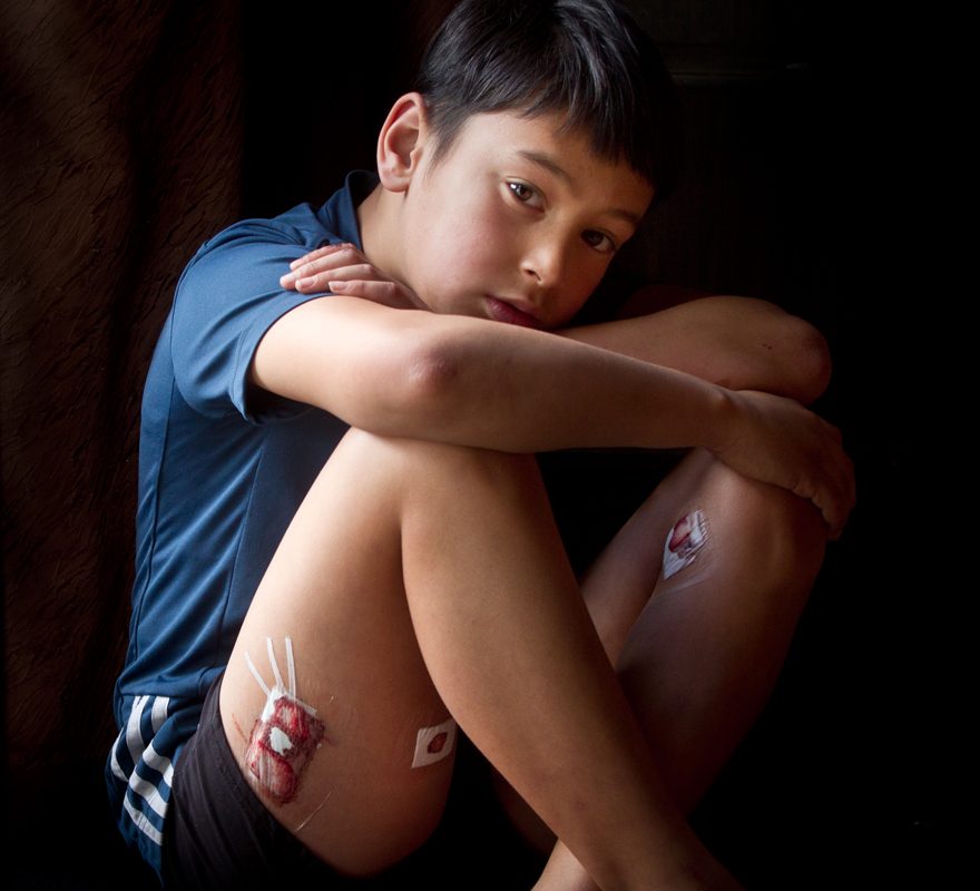 Cameron Bidois, 8, has six bite wounds on his legs and side - four of them deep enough to need paper stitches. Photo/Stephen Parker