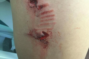 Cameron Bidois dog bite injuries