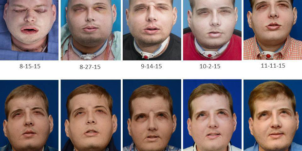 Mississippi volunteer firefighter Patrick Hardison underwent the world's most extensive face transplant one year ago. Photos / New York University Langone Medical Centre.