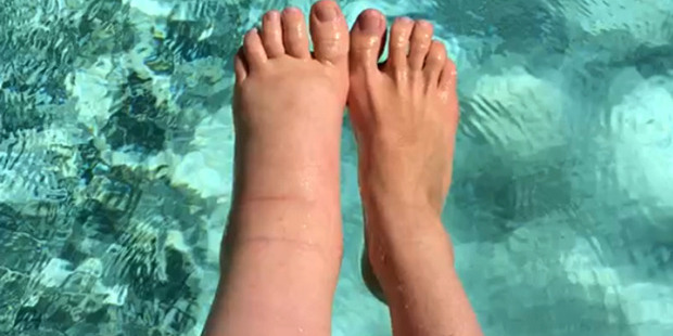 A former model has been left with a ginormous leg after her pregnancy caused the limb to double in size. Photo / Caters