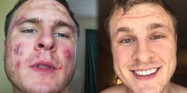 Brian Turner, the 23-year-old American bodybuilder who had a chronic acne problem. Photo / via Instagram