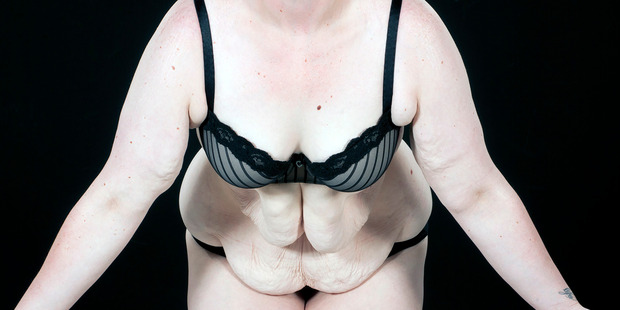 Elora had 2.5kg of excess skin removed. Photo / Martin Hunter, Caters News