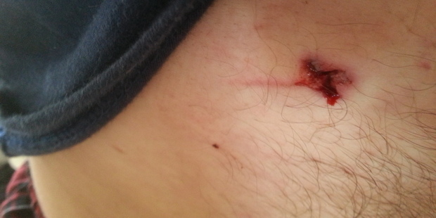 Alistair Brown said it felt like a shark had bitten a chunk out of his torso. Photo / Supplied