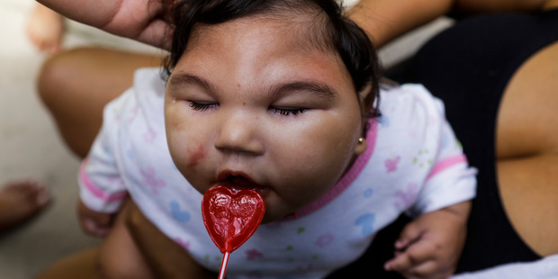 Overseas, Zika has been linked with microcephaly. Photo / Getty Images