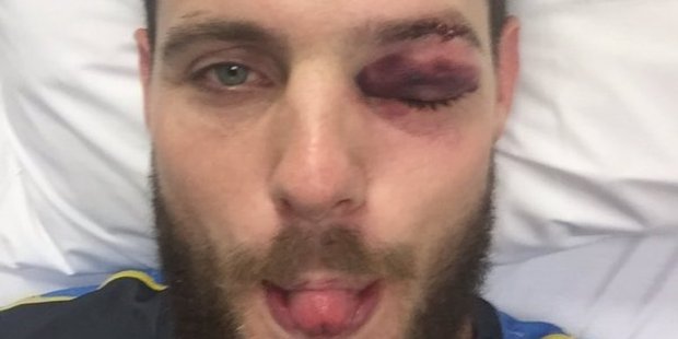 The photo posted to Mitchell McClenaghan's Twitter account after he was hit in the eye while batting at the Basin Reserve today. Photo / Supplied