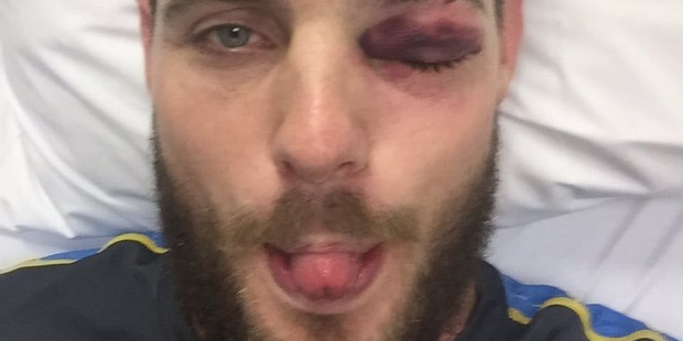 The photo posted to Mitchell McClenaghan's Twitter account after he was hit in the eye while batting at the Basin Reserve today. Photo / Supplied