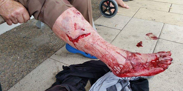The leg of a Waiuku woman after she was attacked by a dog. Photo / Facebook