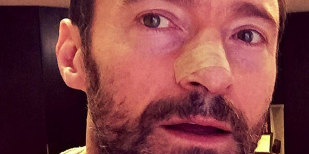 Hugh Jackman shared this photo of his treatment on Instagram.