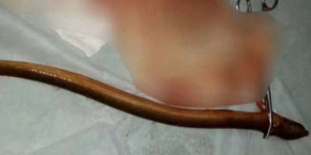 Doctors removed the live eel from the patient's stomach. Photo / Handout / South China Morning Post