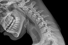 An x-ray of a normal flexed neck. Photo / Getty Images An x-ray of a normal flexed neck. Photo / Getty Images