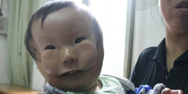 Huikang, born with a rare birth defect, waited to be treated in 2010.
