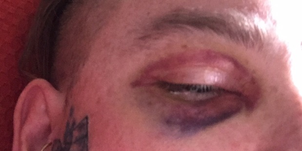 Rossi McGowan is stranded in New Zealand after being attacked last month. Photo / Supplied
