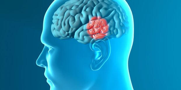 Researchers say the parts of the brain which store memory are the last affected by trauma such as oxygen or blood loss. Photo / File