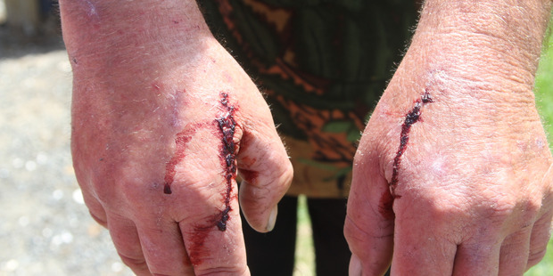 Chris Radich's wounds after the dog attack. Photo / Peter Jackson