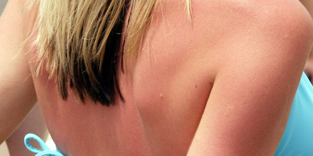 The best treatment for sunburn is prevention but tests by Consumer NZ found some products, including some big brands, do not meet the SPF claimed on the label. Photo / File