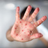 Measles frontline: Stay away from Auckland, parents of unvaccinated kids told